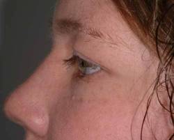Before Image: Patient # 10992 - 