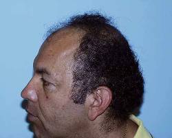 Before Image: Patient # 30986 - 