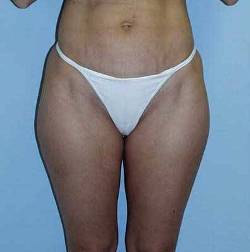Before Image: Patient # 37251 - 