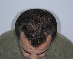 Before Image: Patient # 84213 - 