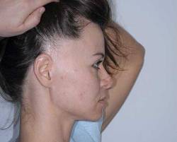 patient with thinning hair before treatment by Dr. Alfonso Barrera