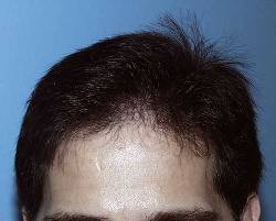 Before Image: Patient # 74924 - 