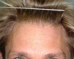 Before Image: Patient # 24703 - 