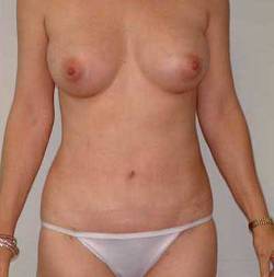 After Image: Patient # 28345 - 