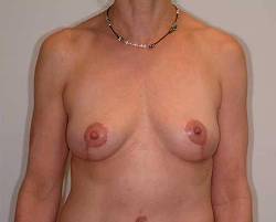 After Image: Patient # 18063 - 