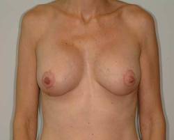 After Image: Patient # 78770 - 