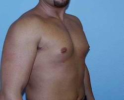 Before Image: Patient # 57972 - 