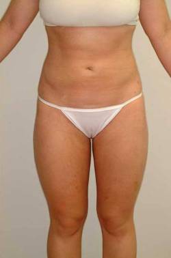 after image of patient who received liposuction by Dr. Barrera in Houston, TX