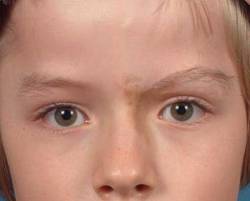 After Image: Patient # 96913 - 
