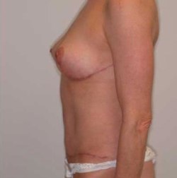 After Image: Patient # 11966 - 