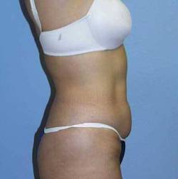 Before Image: Patient # 47300 - 