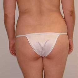 Before Image: Patient # 79803 - 