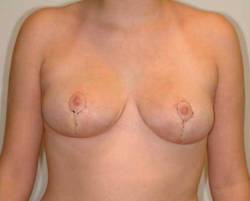 after image of patient who received a breast reduction by Dr. Barrera in Houston, TX