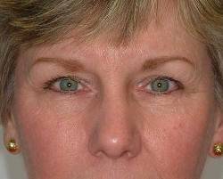 Before Image: Patient # 21807 - 