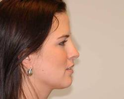 After Image: Patient # 80256 - 