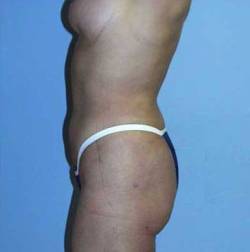 After Image: Patient # 47300 - 