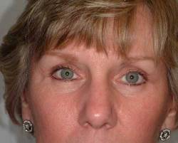 After Image: Patient # 21807 - 