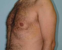 After Image: Patient # 84584 - 