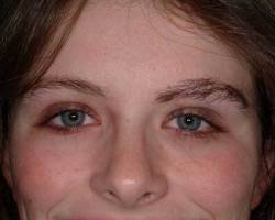 After Image: Patient # 27429 - 