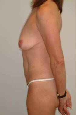 Before Image: Patient # 69593 - 