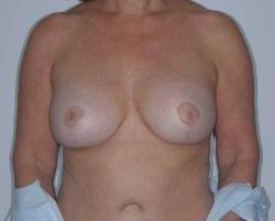 After Image: Patient # 30415 - 