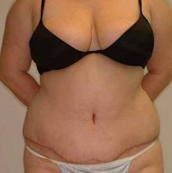 After Image: Patient # 30262 - 