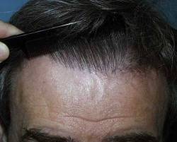 After Image: Patient # 51467 - 