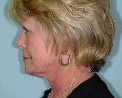 Before Image: Patient # 21982 - 