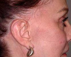 Before Image: Patient # 99398 - 