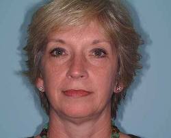 Before Image: Patient # 24341 - 