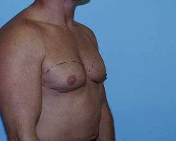 Before Image: Patient # 58006 - 