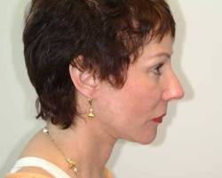 After Image: Patient # 29216 - 