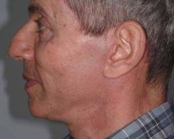 After Image: Patient # 15207 - 