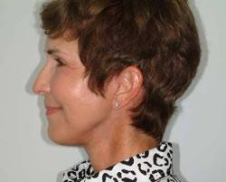 After Image: Patient # 92609 - 