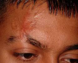 Before Image: Patient # 54163 - 