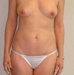 Before Image: Patient # 28345 - 