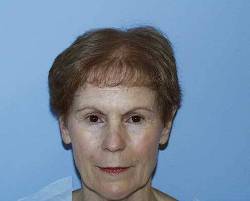 Before Image: Patient # 89341 - 