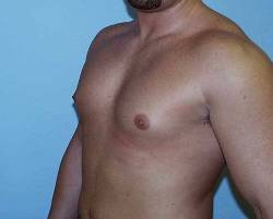 Before Image: Patient # 57972 - 