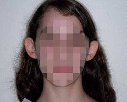 young woman with blurred face before otoplasty ear surgery