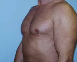 After Image: Patient # 58006 - 