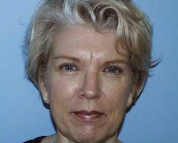 After Image: Patient # 79508 - 