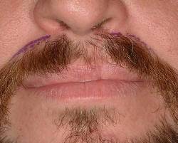 Before Image: Patient # 69317 - 