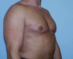 After Image: Patient # 58006 - 
