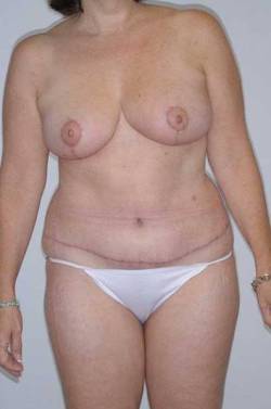 After Image: Patient # 58011 - 