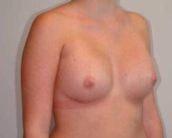 After Image: Patient # 66213 - 