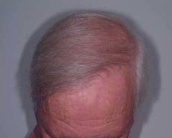 After Image: Patient # 11305 - 