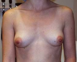Before Image: Patient # 41110 - 
