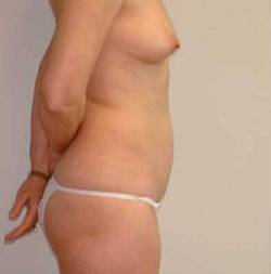 Before Image: Patient # 28345 - 