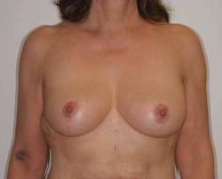 image of patient after undergoing a breast lift by Dr. Alfonso Barrera