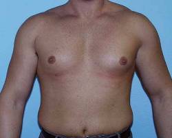 image of patient before gynecomastia male breast reduction procedure